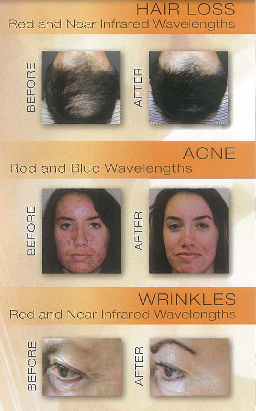 NeoLTS Light Therapy (Hair) - Digenis Plastic Surgery Institute